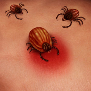Lyme Disease Human Tick